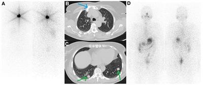Case Report: Regaining radioiodine uptake following PRRT in radioiodine-refractory thyroid cancer: A new re-differentiation strategy?